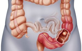 Polyp đại trực tràng: Nguyên nhân, phát hiện, điều trị, phòng ngừa