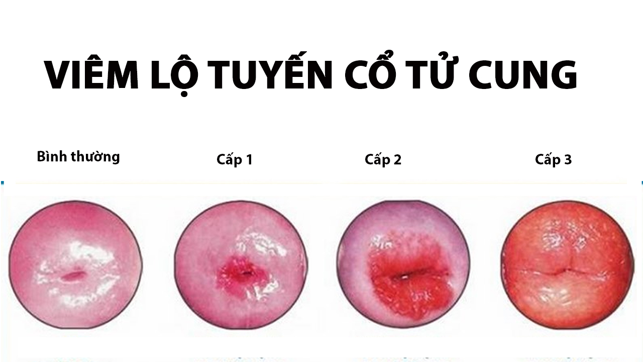 Viêm lộ tuyến 1cm thuộc cấp độ 2