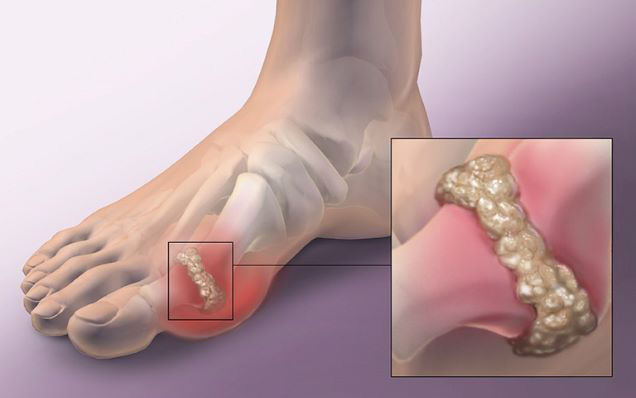 Bệnh gout là gì? Cách điều trị gout hiệu quả nhất 2021