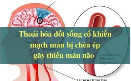 Vì sao thoái hóa đốt sống cổ gây đau đầu? 1