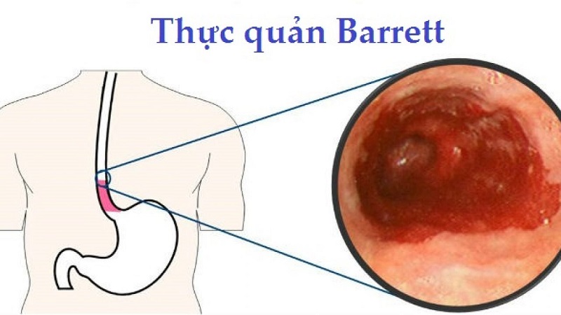 Barrett thực quản là một trong những biến chứng nguy hiểm nhất khi tình trạng trào ngược gây khó thở diễn ra lâu dài.