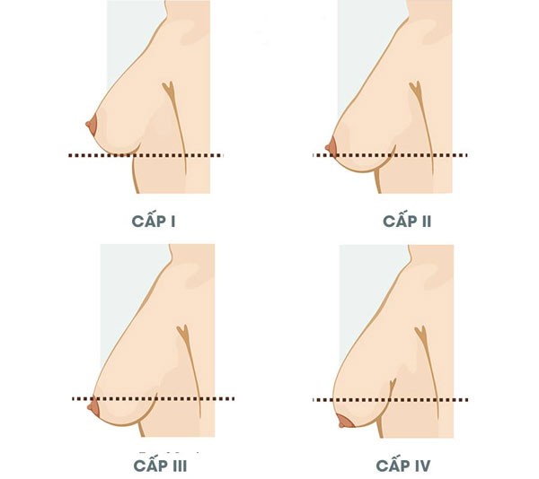 Các cấp độ và phương pháp treo ngực sa trễ an toàn, tốt nhất 2019