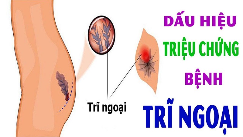 Các dấu hiệu của bệnh trĩ ngoại có thể dễ dàng nhận biết ngay trong giai đoạn đầu