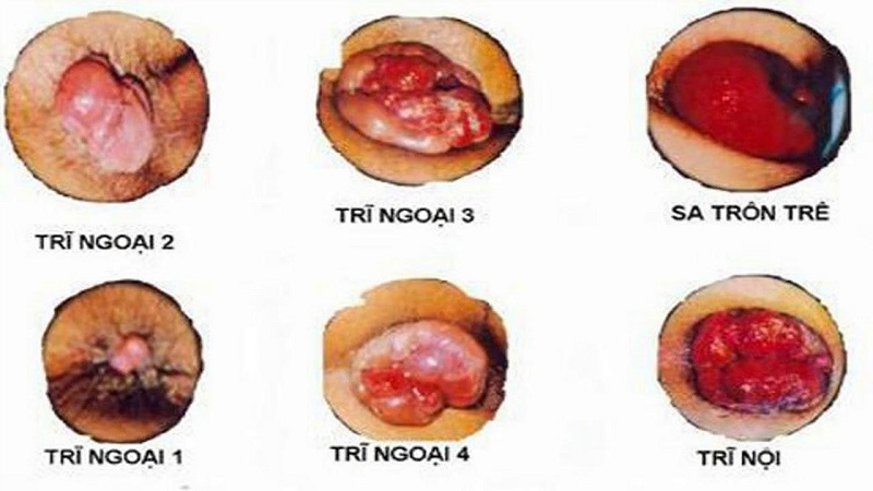 Trĩ ngoại được chia thành 4 cấp độ