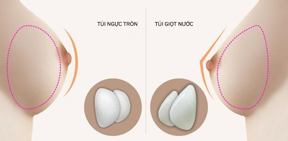 Ngực nhỏ, lép nên nâng ngực túi tròn hay túi giọt nước?