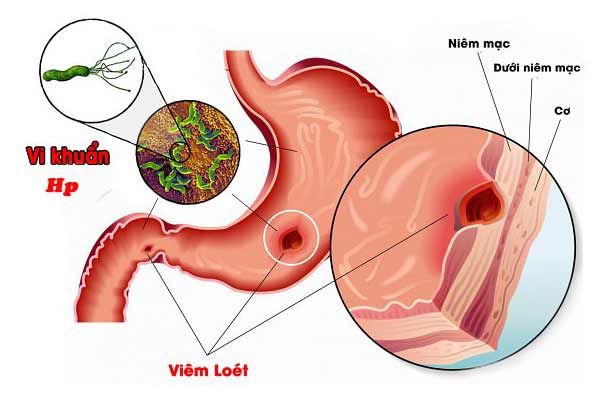 Nhiễm vi khuẩn HP khi mang thai có nguy hiểm không?