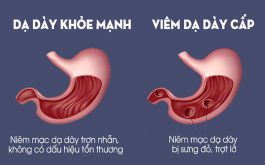 Viêm dạ dày