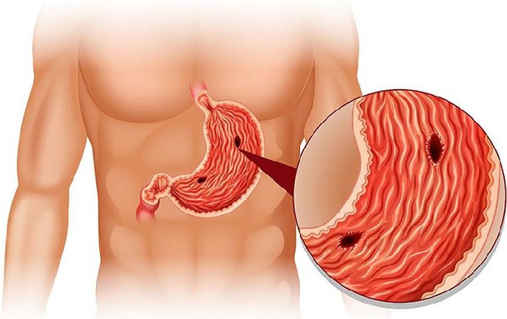 Viêm Dạ Dày Ruột Cấp Là Gì? Nguyên Nhân, Triệu Chứng, Cách Điều Trị