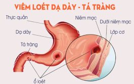 Chế Độ ăn Viêm Loét Dạ Dày Tá Tràng - Bệnh viện Đa khoa Vạn Hạnh