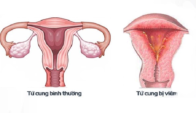 Viêm nội mạc tử cung khiến âm đạo ra khí hư màu xanh