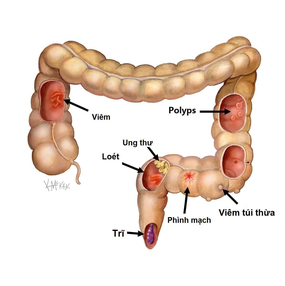 Viêm túi thừa - bệnh lý thường gặp khi bị chảy máu tiêu hóa dưới