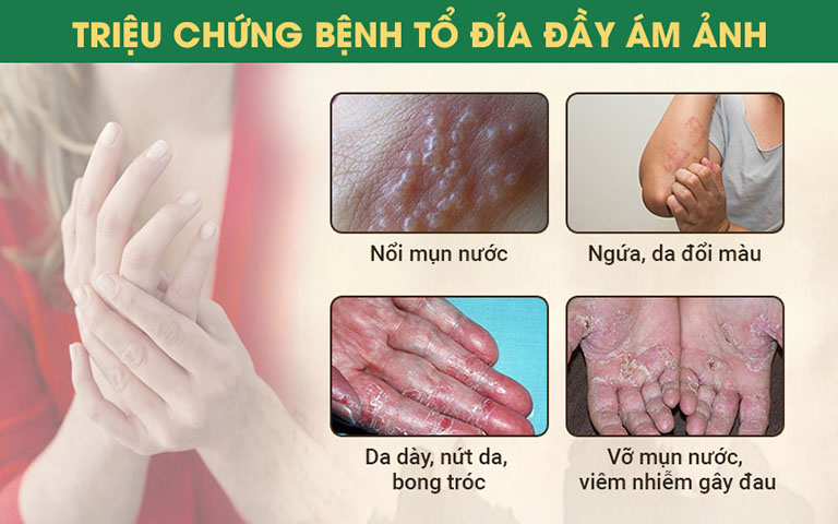 Triệu chứng tổ đỉa