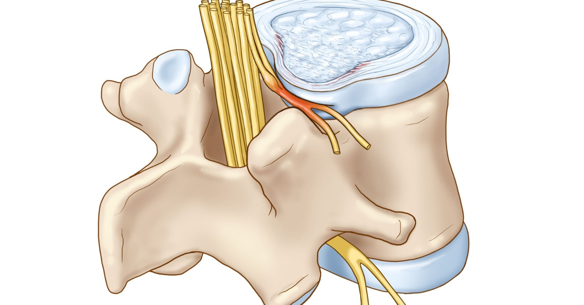 Nguyên nhân do dây thần kinh bị chèn ép