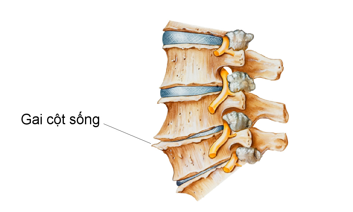 Nguyên nhân đau lưng do gai cột sống thắt lưng