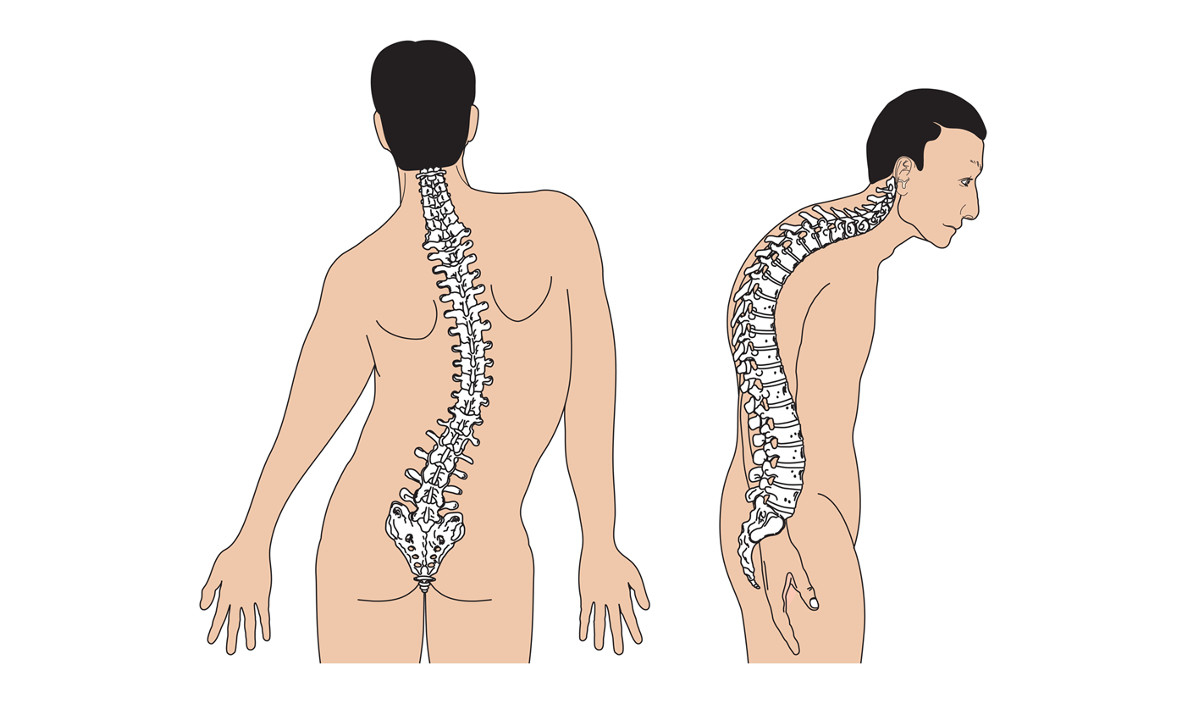 Nguyên nhân đau lưng do Vẹo cột sống thắt lưng