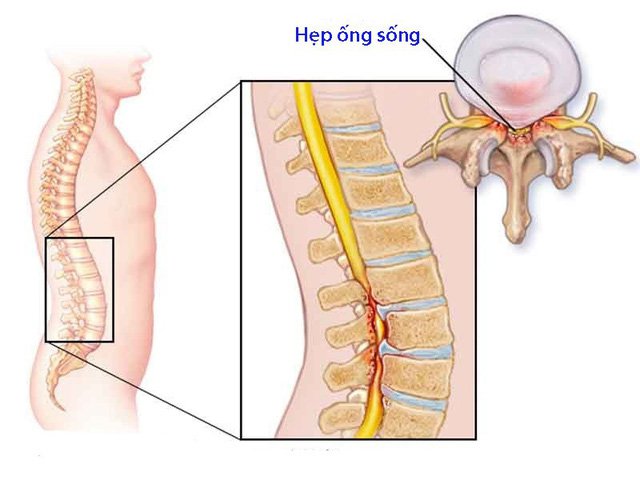 Đau lưng dưới gần mông do hẹp ống sống