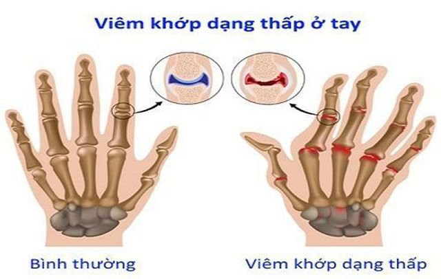 Đau lưng mỏi gối là bệnh gì? Là dấu hiệu của bệnh viêm khớp dạng thấp