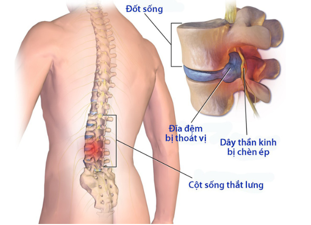 Nguyên nhân đau lưng do Thoát vị đĩa đệm thắt lưng