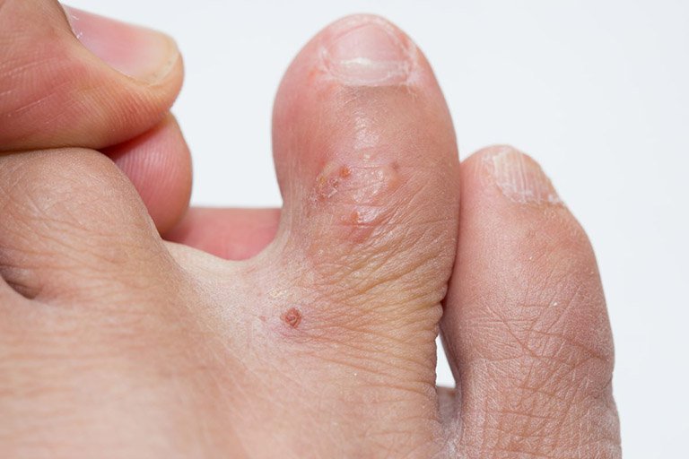 Bệnh tổ đỉa ở ngón chân: Dấu hiệu nhận biết và cách điều trị | Vinmec