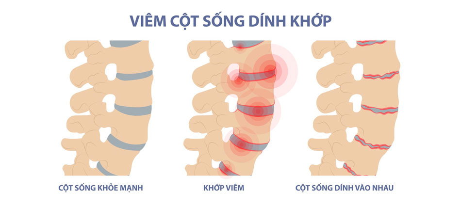 Nguyên nhân đau lưng do Viêm cột sống dính khớp thắt lưng