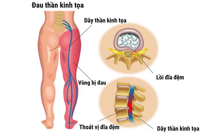 Đau lưng lan xuống chân là biểu hiện của bệnh đau thần kinh tọa