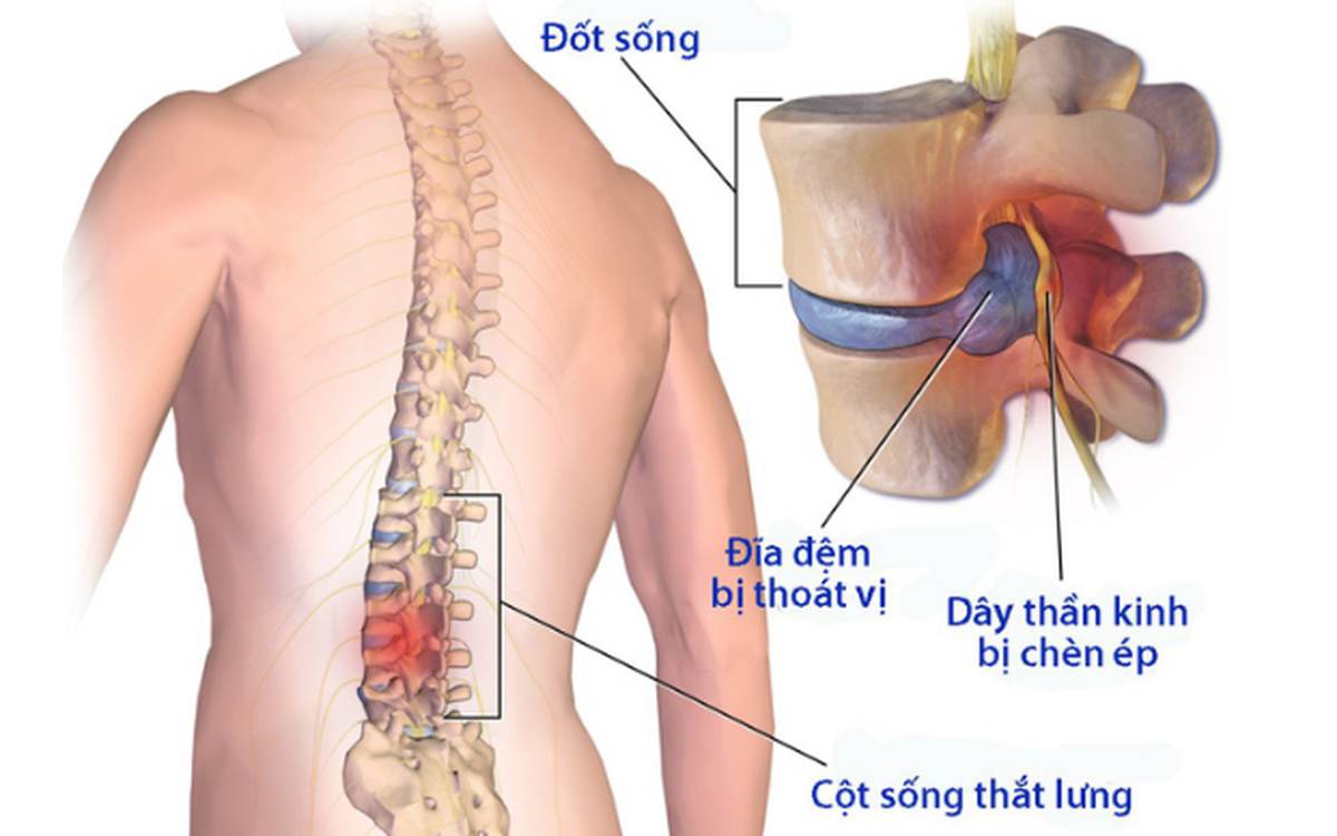 Nguyên nhân đau lưng bên phải do bệnh lý