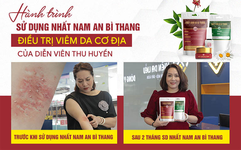 Tình trạng da của nghệ sĩ Thu Huyền trước và sau điều trị