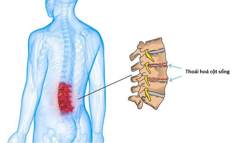 Nguyên nhân đau lưng do thoái hóa cột sống thắt lưng