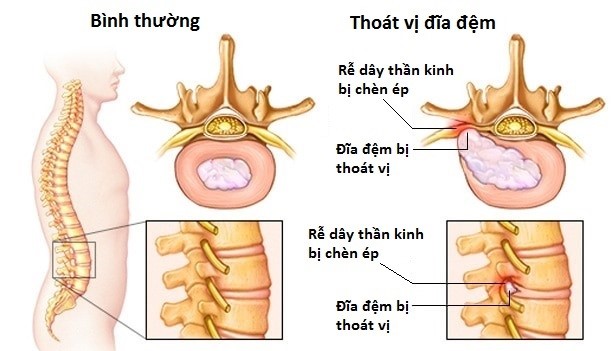 Cách phòng tránh triệu chứng đau lưng lan xuống chân