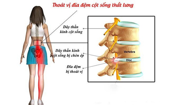 Triệu chứng đau lưng lan xuống chân