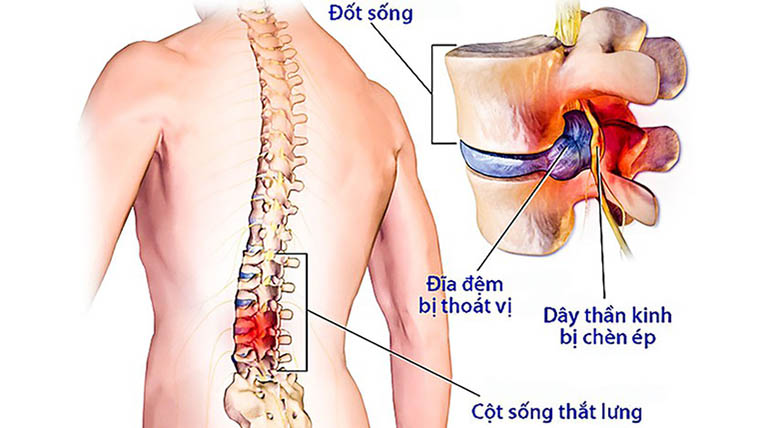 Thoát vị đĩa đệm phổ biến hơn ở lưng dưới nhưng đôi khi cũng có thể xảy ra ở lưng trên