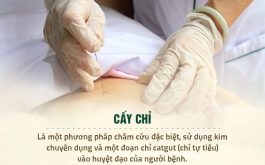 cấy chỉ bao lâu thì có tác dụng